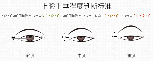 上睑下垂判断标准