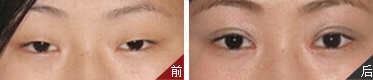 上睑下垂前后对比