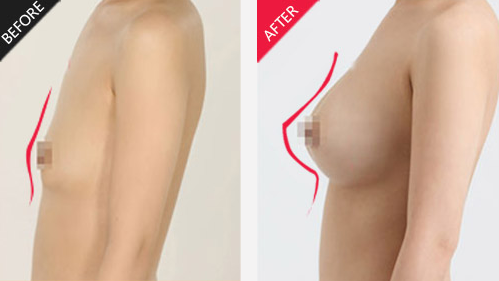 假体隆胸前后对比