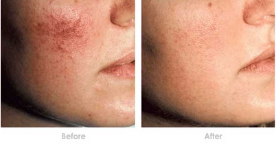 红血丝前后对比