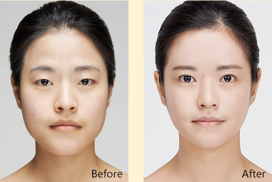 双眼皮前后对比