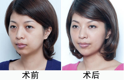 黑眼圈前后对比