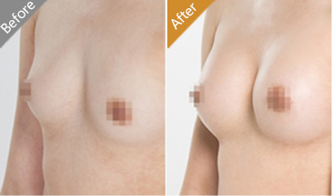 假体隆胸前后对比