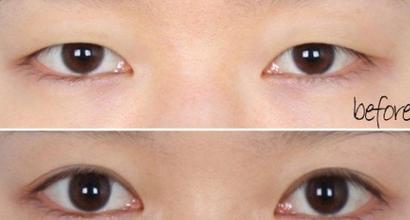上睑下垂前后对比
