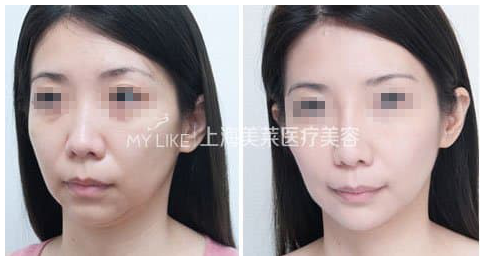 去法令纹前后对比