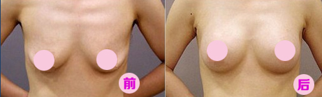 乳房下垂矫正前后对比