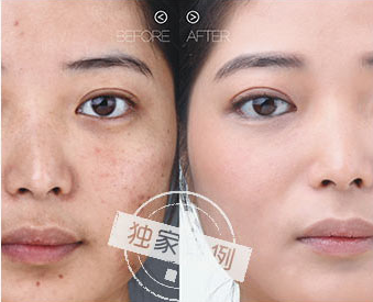 化学酸祛痘