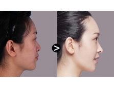 韩式自体软骨隆鼻的优势有哪些
