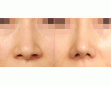 鼻尖缩小术，蒜头鼻也能变成小鼻尖