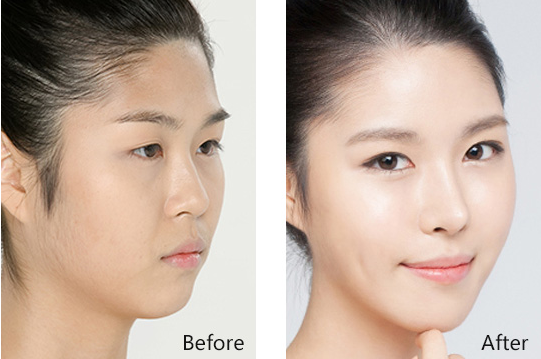 假体隆鼻前后对比