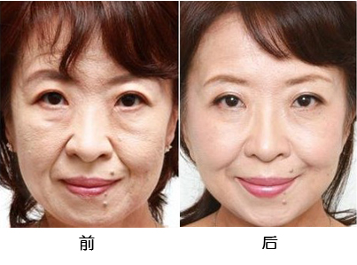 切眉术前后对比