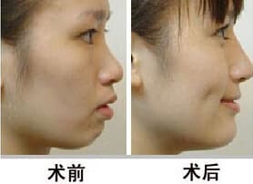 酒窝成形前后对比