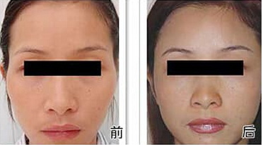 丰太阳穴前后对比