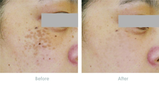 去雀斑前后对比