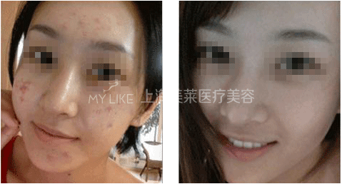 激光祛斑前后对比