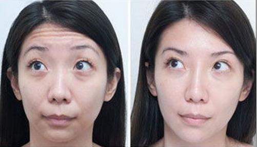 去抬头纹前后对比