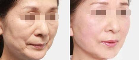 激光祛皱前后对比