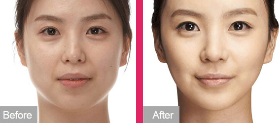 隆下巴前后对比