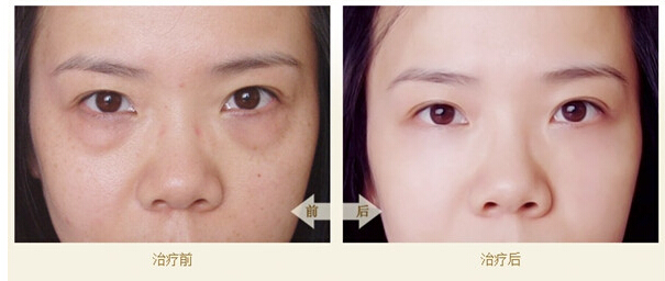 电波拉皮去眼袋前后对比