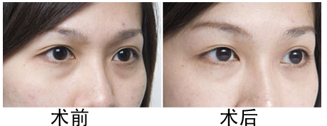 激光去黑眼圈前后对比