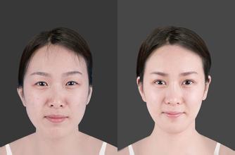 开眼角前后对比