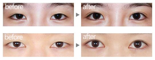 开眼角前后对比