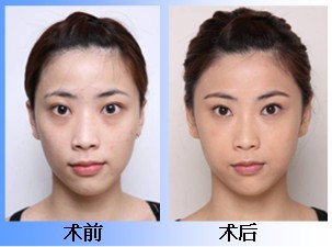 去眼袋前后对比