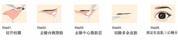 吸脂祛眼袋