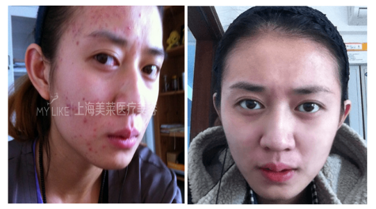 祛痘前后对比