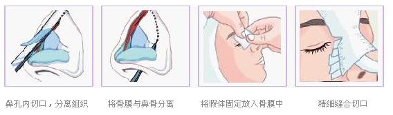 假体隆鼻示意图