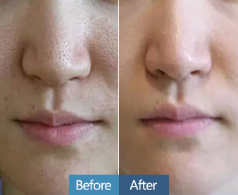 彩光嫩肤收缩毛孔