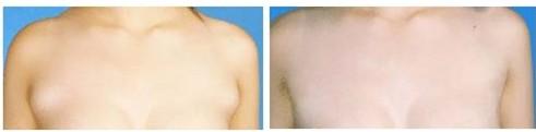 副乳切除