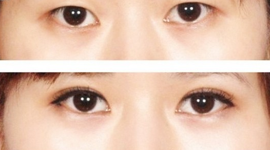 不可忽视的韩式切开准备与护理