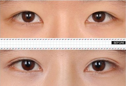 不同类型的双眼皮  总有一个适合你