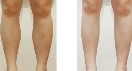 8个吸脂瘦腿术后注意事项