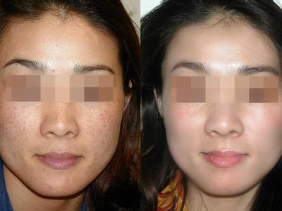 黄褐斑没了  三十岁的女人依旧如花