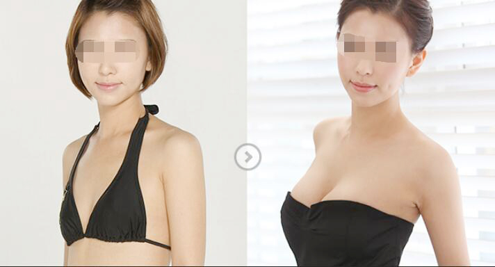 2C平面隐形丰胸 美丽迹