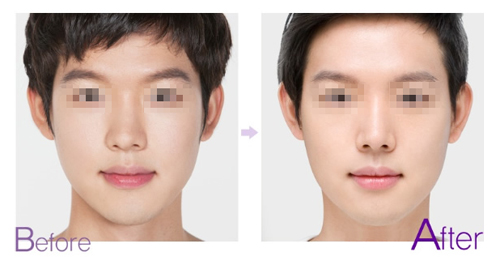 玻尿酸塑造灵巧美鼻