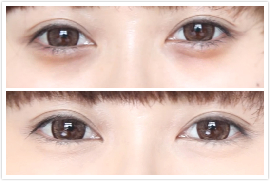 做韩式双眼皮要多少钱