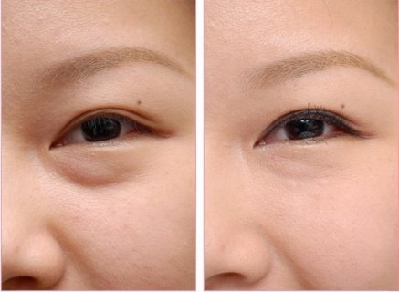 别让眼袋成为年龄的杀手