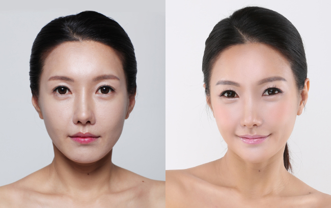 笔直秀气鼻子用自体软骨隆鼻塑出来