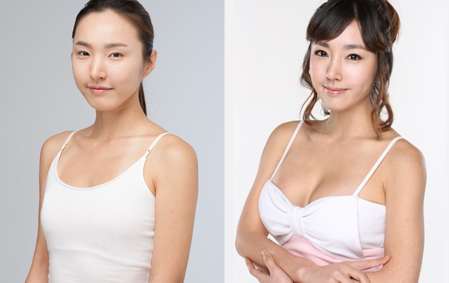 30岁熟女逆袭 隆胸一般要花多少钱