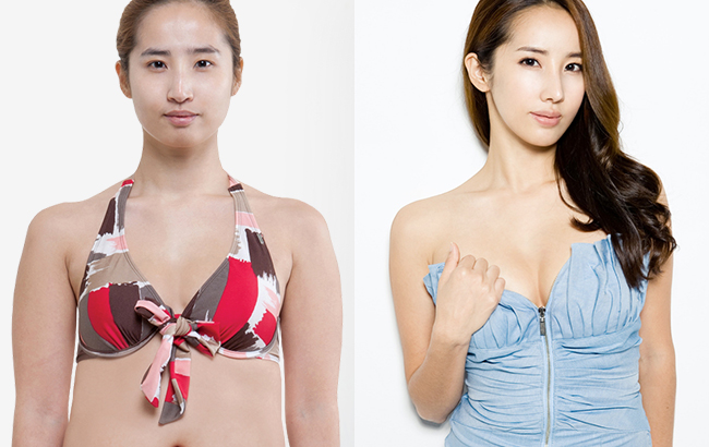 美丽有风险注射隆胸需谨慎