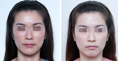 光子嫩肤美白 见证黑皮肤如何自然变白