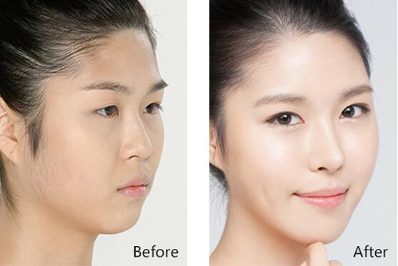 韩式假体隆鼻手术与特点