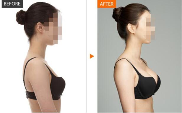 韩式假体隆胸怎么样呢