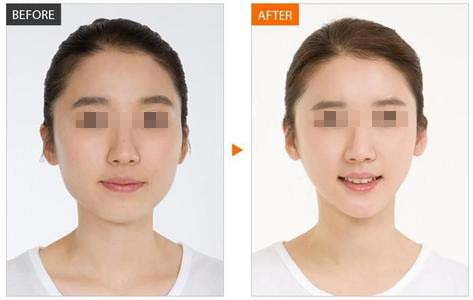 可以进行多次的注射吗