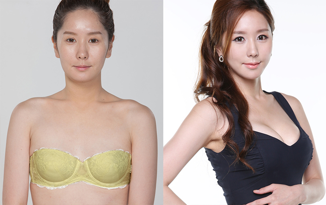 假体丰胸的位置应该如何选择