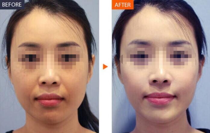 光子嫩肤都有哪些改善肤质的功效呢