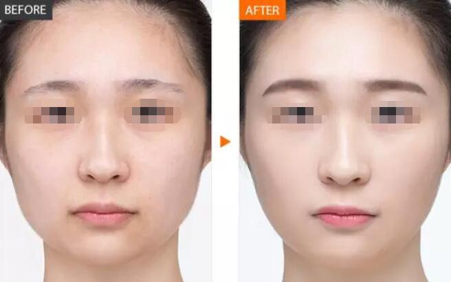 光子嫩肤解决毛孔粗大细腻肌肤